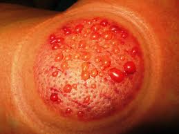 KENAPA ADA AIR MACAM MELEPUH/ BLISTER DEKAT TEMPAT LEPAS 
